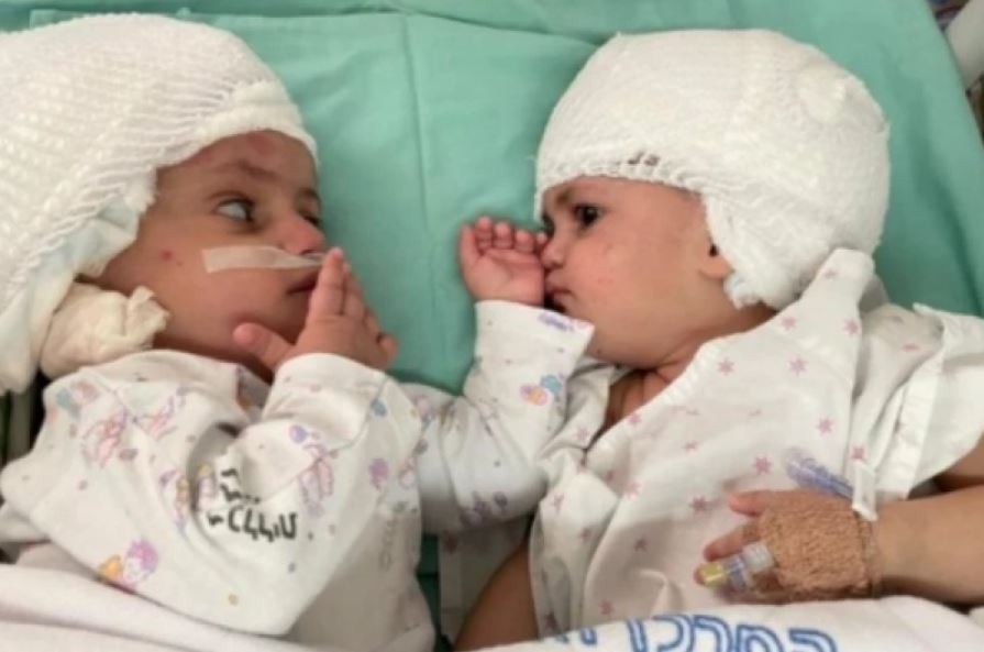 Емотивна средба на сестрите кои се виделе за првпат: Успешно се раздвоени сијамските близначки