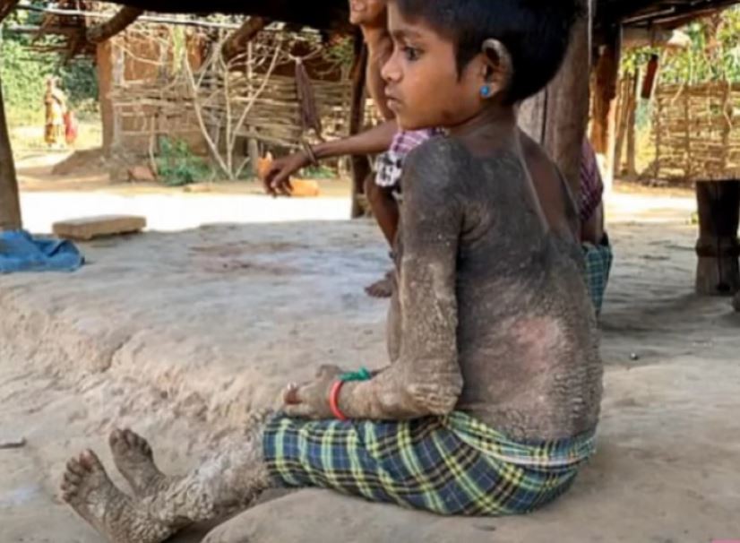 Седумгодишно девојче се претвора во камен: Боледува од ретка болест, а секој нов ден за неа е повеќе од мачен