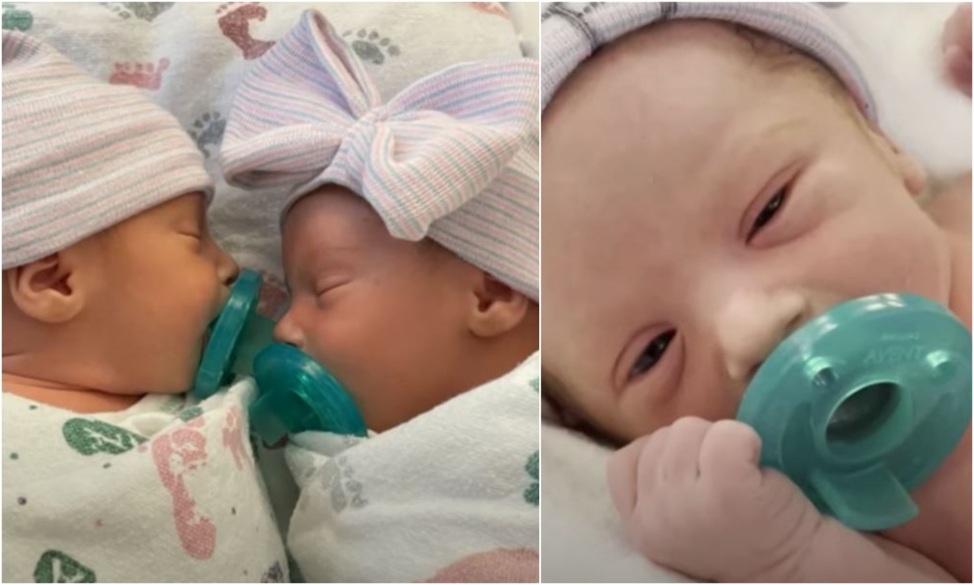 Мал борец: Близначка родена со едно белодробно крило ги победи сите лоши прогнози на лекарите