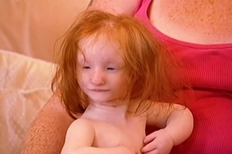 Родена е како порцеланска кукла, докторите прогнозирале дека ќе живее само 1 година: Како изгледа денес најмалото девојче на светот? (ФОТО)