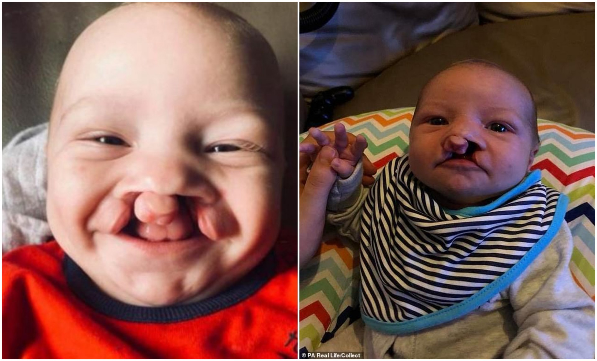 Роден е со расцеп на усната и непцето: По двете операции ги освојува сите со неодоливата насмевка (ФОТО)