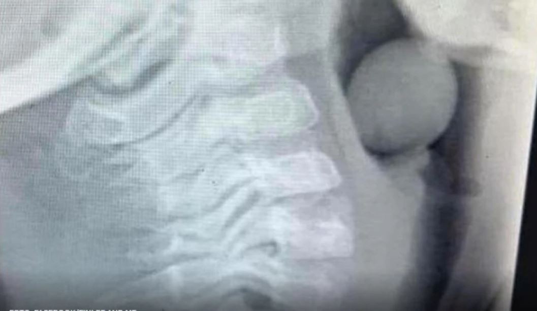 Петгодишно момче поради гушење завршило во болница: Шокантната рендген снимка се гледа што голтнало (ФОТО)