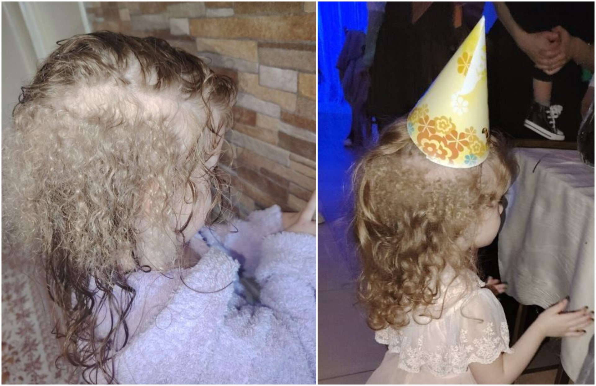 Чуден феномен: На девојче од Лесковац ѝ расте три вида на коса, лекарите збунети