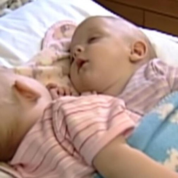 Родени се како сијамски близначки, а 3 месеци подоцна се разделени со операција: Како живеат 10 години потоа?