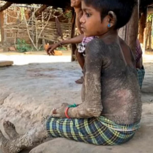 Седумгодишно девојче се претвора во камен: Боледува од ретка болест, а секој нов ден за неа е повеќе од мачен