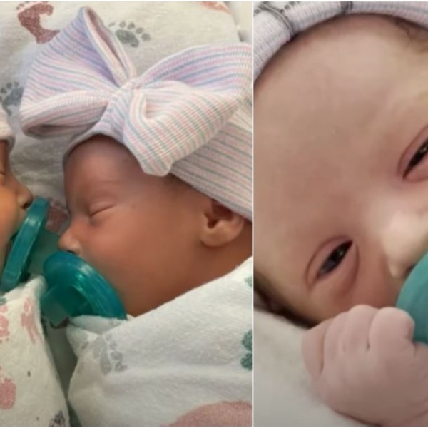 Мал борец: Близначка родена со едно белодробно крило ги победи сите лоши прогнози на лекарите