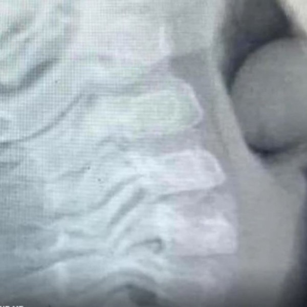 Петгодишно момче поради гушење завршило во болница: Шокантната рендген снимка се гледа што голтнало (ФОТО)